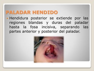 PALADAR HENDIDO
 Hendidura posterior se extiende por las
regiones blandas y duras del paladar
hasta la fosa incisiva, separando las
partes anterior y posterior del paladar.
 