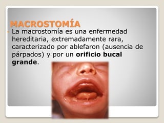 MACROSTOMÍA
• La macrostomía es una enfermedad
hereditaria, extremadamente rara,
caracterizado por ablefaron (ausencia de
párpados) y por un orificio bucal
grande.
 