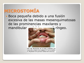 MICROSTOMÍA
 Boca pequeña debido a una fusión
excesiva de las masas mesenquimatosas
de las prominencias maxilares y
mandibulares del 1er arco faríngeo.
 