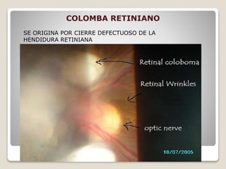 COLOMBA RETINIANO
SE ORIGINA POR CIERRE DEFECTUOSO DE LA
HENDIDURA RETINIANA
 