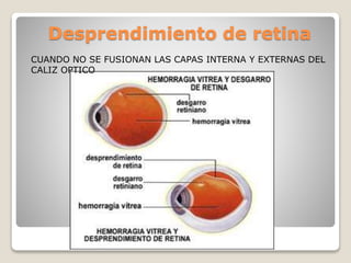 Desprendimiento de retina
CUANDO NO SE FUSIONAN LAS CAPAS INTERNA Y EXTERNAS DEL
CALIZ OPTICO
 