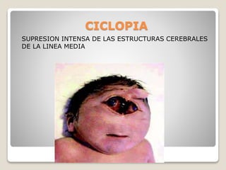 CICLOPIA
SUPRESION INTENSA DE LAS ESTRUCTURAS CEREBRALES
DE LA LINEA MEDIA
 