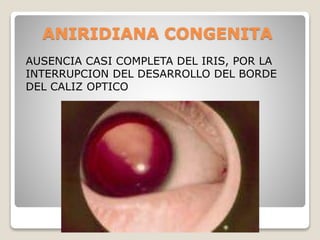 ANIRIDIANA CONGENITA
AUSENCIA CASI COMPLETA DEL IRIS, POR LA
INTERRUPCION DEL DESARROLLO DEL BORDE
DEL CALIZ OPTICO
 
