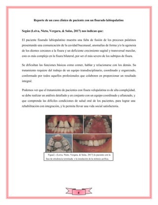 4
Reporte de un caso clínico de paciente con un fisurado labiopalatino
Según (Leiva, Nieto, Vergara, & Salas, 2017) nos indican que:
El paciente fisurado labiopalatino muestra una falta de fusión de los procesos palatinos
presentando una comunicación de la cavidad buconasal, anomalías de forma y/o la agenesia
de los dientes cercanos a la fisura y un deficiente crecimiento sagital y transversal maxilar,
esto es más complejo en la fisura bilateral, por ser el más severo de los subtipos de fisura.
Se dificultan las funciones básicas como comer, hablar y relacionarse con los demás. Su
tratamiento requiere del trabajo de un equipo transdisciplinario, coordinado y organizado,
conformado por todos aquellos profesionales que colaboren en proporcionar un resultado
integral.
Podemos ver que el tratamiento de pacientes con fisura velopalatina es de alta complejidad,
se debe realizar un análisis detallado y en conjunto con un equipo coordinado y afianzado, y
que comprenda las difíciles condiciones de salud oral de los pacientes, para lograr una
rehabilitación con integración, y le permita llevar una vida social satisfactoria.
FfFigua2.- (Leiva, Nieto, Vergara, & Salas, 2017) la paciente con la
fase de ortodoncia terminada, y la instalación de la prótesis acrílica,
 