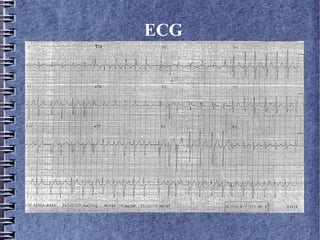 ECG
 