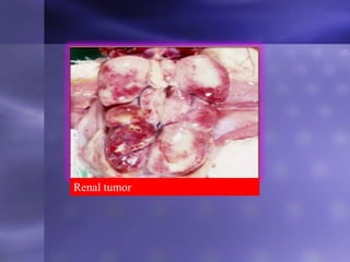 Renal tumor
 