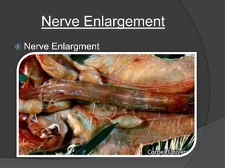 Nerve Enlargement
 Nerve Enlargment
 