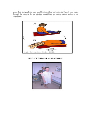 abajo. Este test puede ser más sensible si se utiliza los Lentes de Frenzel o un video
Frenzel. La mayoría de los médicos especialistas en mareos tienen ambos en su
consultorio.
DESVIACION POSTURAL DE ROMBERG
 