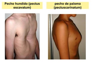 Pecho hundido (pectus
escavatum)
pecho de paloma
(pectuscarinatum)
 