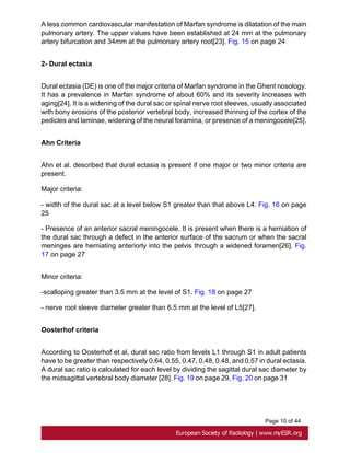 Page 10 of 44
A less common cardiovascular manifestation of Marfan syndrome is dilatation of the main
pulmonary artery. The upper values have been established at 24 mm at the pulmonary
artery bifurcation and 34mm at the pulmonary artery root[23]. Fig. 15 on page 24
2- Dural ectasia
Dural ectasia (DE) is one of the major criteria of Marfan syndrome in the Ghent nosology.
It has a prevalence in Marfan syndrome of about 60% and its severity increases with
aging[24]. It is a widening of the dural sac or spinal nerve root sleeves, usually associated
with bony erosions of the posterior vertebral body, increased thinning of the cortex of the
pedicles and laminae, widening of the neural foramina, or presence of a meningocele[25].
Ahn Criteria
Ahn et al. described that dural ectasia is present if one major or two minor criteria are
present.
Major criteria:
- width of the dural sac at a level below S1 greater than that above L4. Fig. 16 on page
25
- Presence of an anterior sacral meningocele. It is present when there is a herniation of
the dural sac through a defect in the anterior surface of the sacrum or when the sacral
meninges are herniating anteriorly into the pelvis through a widened foramen[26]. Fig.
17 on page 27
Minor criteria:
-scalloping greater than 3.5 mm at the level of S1. Fig. 18 on page 27
- nerve root sleeve diameter greater than 6.5 mm at the level of L5[27].
Oosterhof criteria
According to Oosterhof et al, dural sac ratio from levels L1 through S1 in adult patients
have to be greater than respectively 0.64, 0.55, 0.47, 0.48, 0.48, and 0,57 in dural ectasia.
A dural sac ratio is calculated for each level by dividing the sagittal dural sac diameter by
the midsagittal vertebral body diameter [28]. Fig. 19 on page 29, Fig. 20 on page 31
 