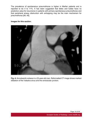 Page 14 of 44
The prevalence of spontaneous pneumothorax is higher in Marfan patients and is
reported to be 4 to 11%. It has been suggested that blebs and bullae have no
predictive value for recurrence in patients with primary spontaneous pneumothorax and
that peripheral airway obstruction with airtrapping may be the main mechanism for
pneumothorax [48, 49].
Images for this section:
Fig. 4: Annuloaortic ectasia in a 23-year-old man. Reformatted CT image shows marked
dilatation of the Valsalva sinus and the sinotubular junction.
 