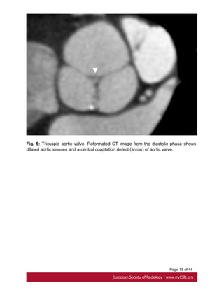 Page 15 of 44
Fig. 5: Tricuspid aortic valve. Reformated CT image from the diastolic phase shows
dilated aortic sinuses and a central coaptation defect (arrow) of aortic valve.
 