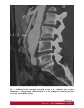Page 16 of 44
Fig. 6: Abdominal aortic aneurysm and dural ectasia in a 27-year-old man. Sagittal
reformated CT image shows fusiform dilatation of the infrarenal abdominal aorta and
scalloping on S1 vertebral body.
 