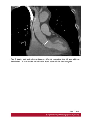 Page 17 of 44
Fig. 7: Aortic root and valve replacement (Bentall operation) in a 48 year old man.
Reformated CT scan shows the mechanic aortic valve and the vascular graft.
 
