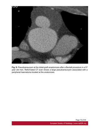 Page 19 of 44
Fig. 9: Pseudoaneurysm at the distal graft anastomosis after a Bentall procedure in a 57
year old man. Reformated CT scan shows a large pseudoaneurysm associated with a
peripheral haematoma located at the anatomosis.
 