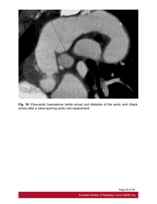 Page 20 of 44
Fig. 10: Para-aortic haematoma (white arrow) and dilatation of the aortic arch (black
arrow) after a valve-sparring aortic root replacement.
 