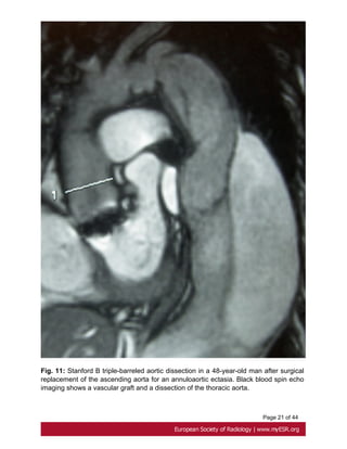 Page 21 of 44
Fig. 11: Stanford B triple-barreled aortic dissection in a 48-year-old man after surgical
replacement of the ascending aorta for an annuloaortic ectasia. Black blood spin echo
imaging shows a vascular graft and a dissection of the thoracic aorta.
 