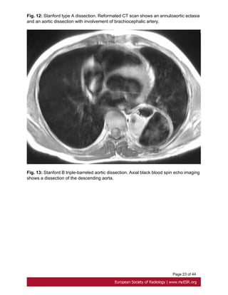 Page 23 of 44
Fig. 12: Stanford type A dissection. Reformated CT scan shows an annuloaortic ectasia
and an aortic dissection with involvement of brachiocephalic artery.
Fig. 13: Stanford B triple-barreled aortic dissection. Axial black blood spin echo imaging
shows a dissection of the descending aorta.
 