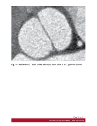 Page 24 of 44
Fig. 14: Reformated CT scan shows a bicuspid aortic valve in a 47-year-old woman.
 