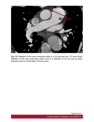 Page 25 of 44
Fig. 15: Dilatation of the main pulmonary artery in a 32-year-old men. CT scan shows
dilatation of the main pulmonary artery trunk to a diameter of 45 mm and an aortic
dissection with an intimal flap in thoracic aorta.
 