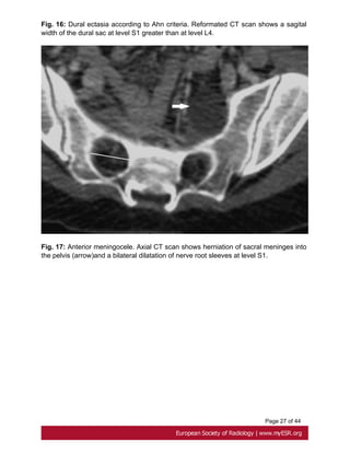 Page 27 of 44
Fig. 16: Dural ectasia according to Ahn criteria. Reformated CT scan shows a sagital
width of the dural sac at level S1 greater than at level L4.
Fig. 17: Anterior meningocele. Axial CT scan shows herniation of sacral meninges into
the pelvis (arrow)and a bilateral dilatation of nerve root sleeves at level S1.
 