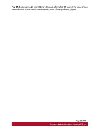 Page 35 of 44
Fig. 21: Scoliosis in a 27 year old man. Coronal reformated CT scan of the spine shows
thoracolumbar spinal curvature with development of marginal osteophytes.
 