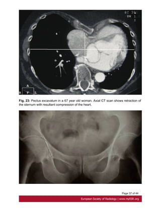 Page 37 of 44
Fig. 23: Pectus excavatum in a 67 year old woman. Axial CT scan shows retraction of
the sternum with resultant compression of the heart.
 