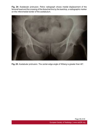 Page 38 of 44
Fig. 24: Acetabular protrusion. Pelvic radiograph shows medial displacement of the
femoral head and the crossing of the ilioischial line by the teardrop, a radiographic marker
on the inferomedial border of the acetabulum.
Fig. 25: Acetabular protrusion. The center-edge angle of Wiberg is greater than 40°.
 