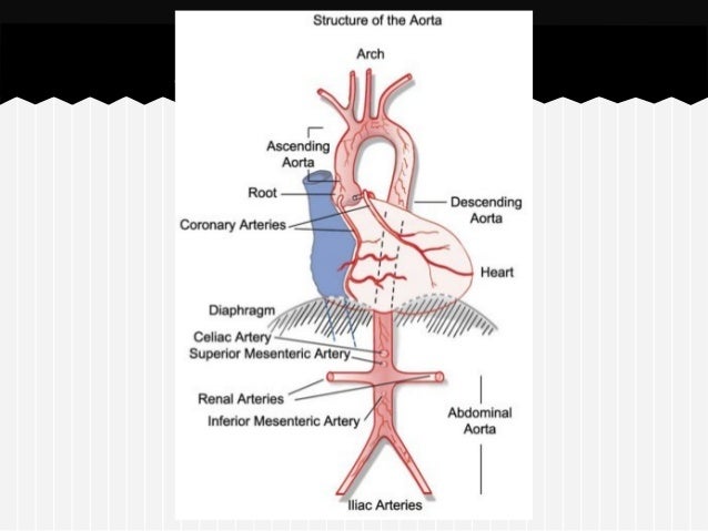Marfan syndrome
