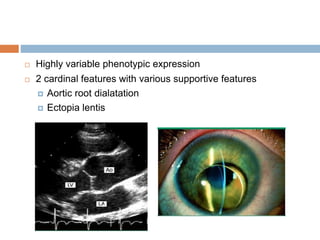  Highly variable phenotypic expression
 2 cardinal features with various supportive features
 Aortic root dialatation
 Ectopia lentis
 