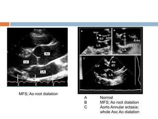 A Normal
B MFS; Ao root dialation
C Aorto Annular ectasia;
whole Asc Ao dialation
MFS; Ao root dialation
 