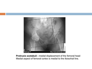 Protrusio acetabuli - medial displacement of the femoral head
Medial aspect of femoral cortex is medial to the ilioischial line.
 
