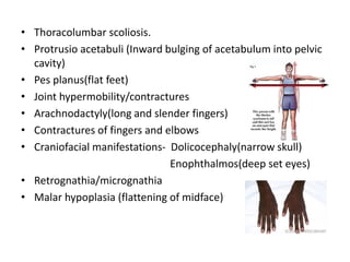• Thoracolumbar scoliosis.
• Protrusio acetabuli (Inward bulging of acetabulum into pelvic
cavity)
• Pes planus(flat feet)
• Joint hypermobility/contractures
• Arachnodactyly(long and slender fingers)
• Contractures of fingers and elbows
• Craniofacial manifestations- Dolicocephaly(narrow skull)
Enophthalmos(deep set eyes)
• Retrognathia/micrognathia
• Malar hypoplasia (flattening of midface)
 