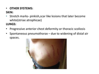 • OTHER SYSTEMS:
SKIN:
• Stretch marks- pinkish,scar like lesions that later become
white(striae atrophicae)
LUNGS:
• Progressive anterior chest deformity or thoracic scoliosis
• Spontaneous pneumothorax – due to widening of distal air
spaces.
 