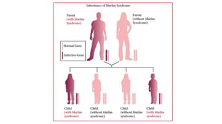 Marfan Inheritance Pattern Marfan syndrome | PPTX