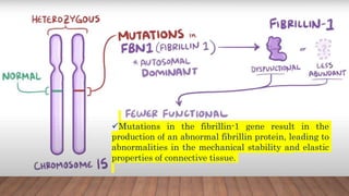 MFS was traditionally considered to result from a
structural deficiency of connective tissues.
Mutations in the fibrillin-1 gene result in the
production of an abnormal fibrillin protein, leading to
abnormalities in the mechanical stability and elastic
properties of connective tissue.
 