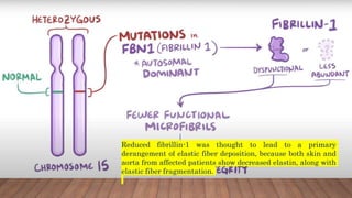Reduced fibrillin-1 was thought to lead to a primary
derangement of elastic fiber deposition, because both skin and
aorta from affected patients show decreased elastin, along with
elastic fiber fragmentation.
 