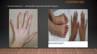 CONTINUED
• Arachnodactyly — abnomally long and slender fingers.
 