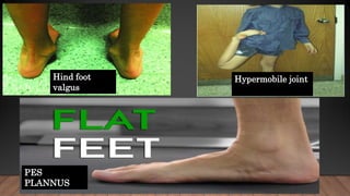 Hind foot
valgus
PES
PLANNUS
Hypermobile joint
 