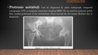CONTINUED
• Protrusio acetabuli Can be diagnosed by plain radiograph, computed
tomography (CT), or magnetic resonance imaging (MRI). On an anterior-posterior pelvic
film, medial protrusion of the acetabulum ≥3mm beyond the ilio-ischial (Kohler) line is
diagnostic.
 