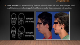CONTINUED
• Facial features — dolichocephaly (reduced cephalic index or head width/length ratio),
enophthalmos, downslanting palpebral fissures, malar hypoplasia, and retrognathia.
 