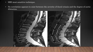 • MRI most sensitive technique.
• No correlation appears to exist between the severity of dural ectasia and the degree of aortic
dilatation.
 