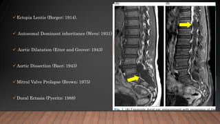  Ectopia Lentis (Borger; 1914).
 Autosomal Dominant inheritance (Weve; 1931)
 Aortic Dilatation (Etter and Grover; 1943)
 Aortic Dissection (Baer; 1943)
 Mitral Valve Prolapse (Brown; 1975)
 Dural Ectasia (Pyeritz; 1988)
 