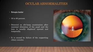 OCULAR ABNORMALITIES
• Ectopia lentis:
• 50 to 80 percent.
• Detected on slit-lamp examination after
maximal dilatation of the pupil and the
lens is usually displaced upward and
temporally.
• It is caused by failure of the supporting
ciliary zonules.
 