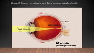 • Myopia >3 diopters - secondary myopia due to increased axis globe length.
 