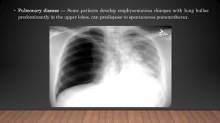• Pulmonary disease — Some patients develop emphysematous changes with lung bullae
predominantly in the upper lobes, can predispose to spontaneous pneumothorax.
 