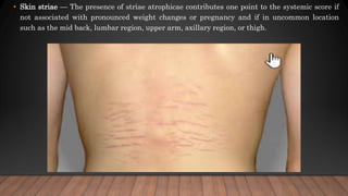 • Skin striae — The presence of striae atrophicae contributes one point to the systemic score if
not associated with pronounced weight changes or pregnancy and if in uncommon location
such as the mid back, lumbar region, upper arm, axillary region, or thigh.
 