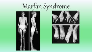 Marfan Syndrome
 
