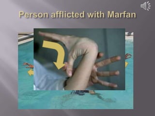 Person afflicted with Marfan