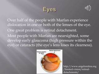 EyesOver half of the people with Marfan experience dislocation in one or both of the lenses of the eye.One great problem is retinal detachment. Most people with Marfan are nearsighted, some develop early glaucoma (high pressure within the eye) or cataracts (the eye’s lens loses its clearness). http://www.angeloretina.org/limited-vision/retinal-detachments/